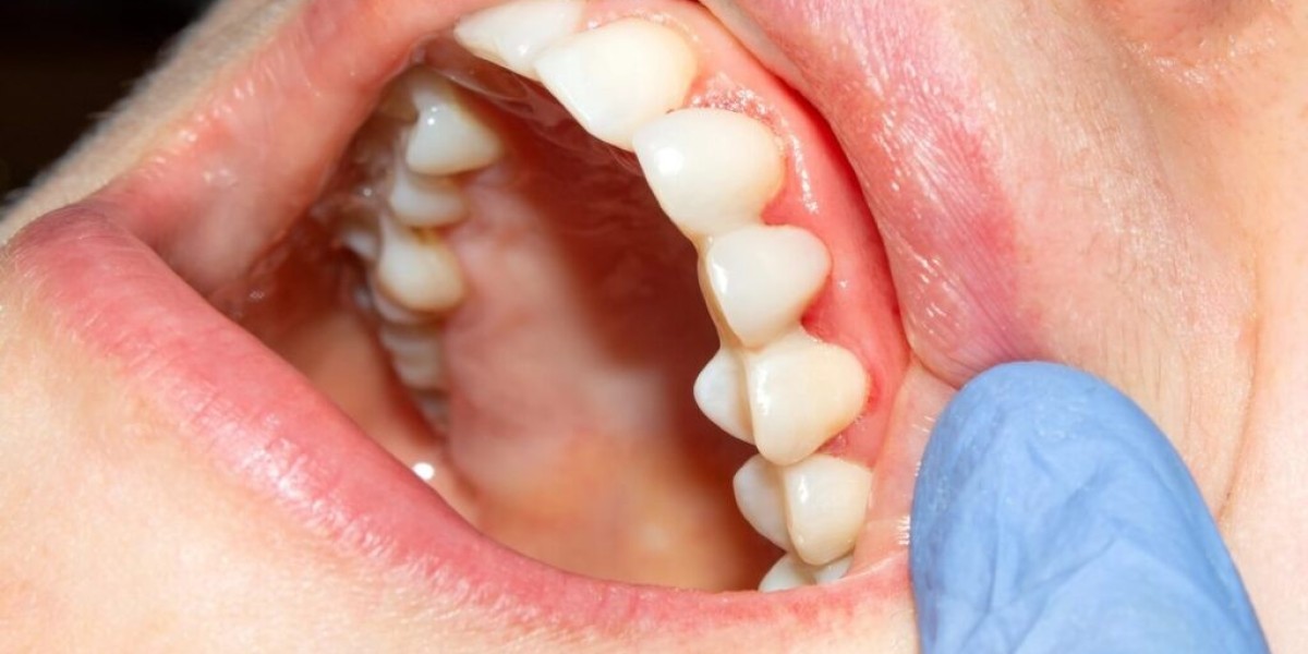 Tooth Filling Cost: Does the Size of the Cavity Matter?