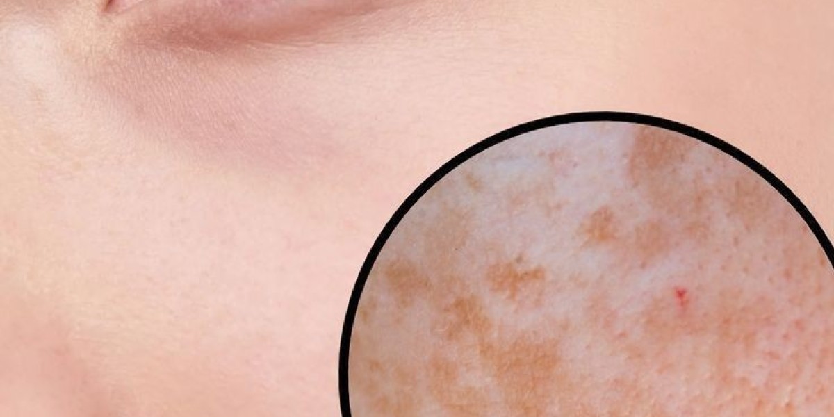 Birthmark Removal in Dubai: Post-Treatment Care for Long-Lasting Results