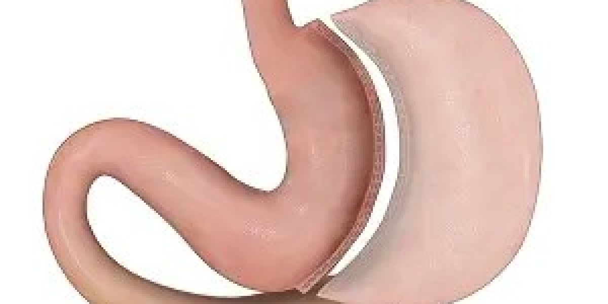 Can Gastric Sleeve Surgery Improve Sleep Apnea?