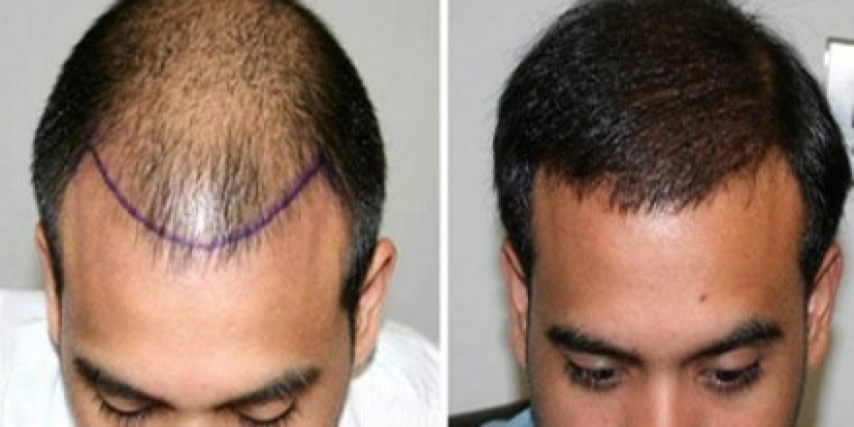 ? أفضل نتائج زراعة الشعر في الرياض: كثافة طبيعية ومظهر شبابي ?