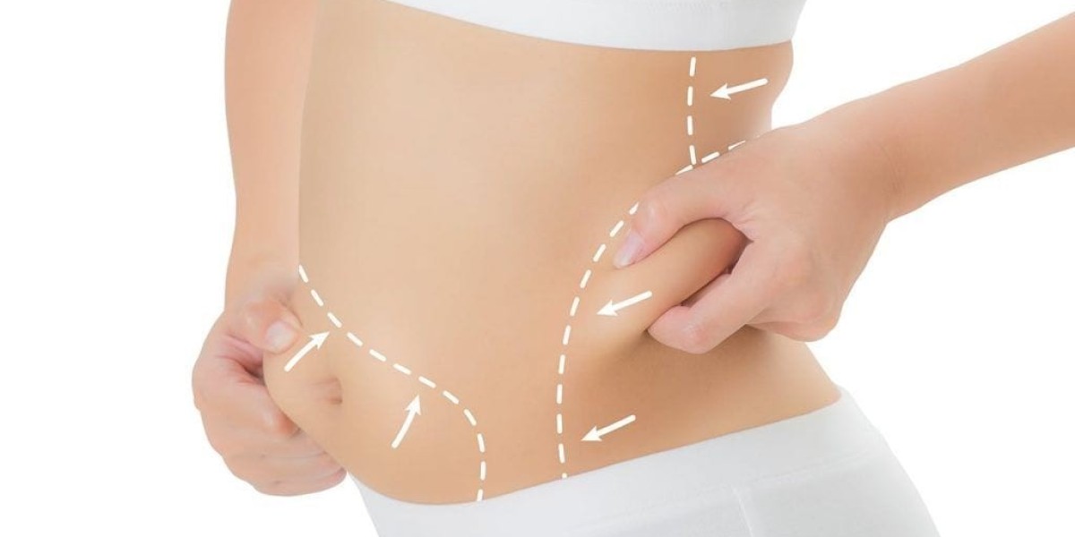 Recovery After Liposuction: Timeline and Tips for Best Results