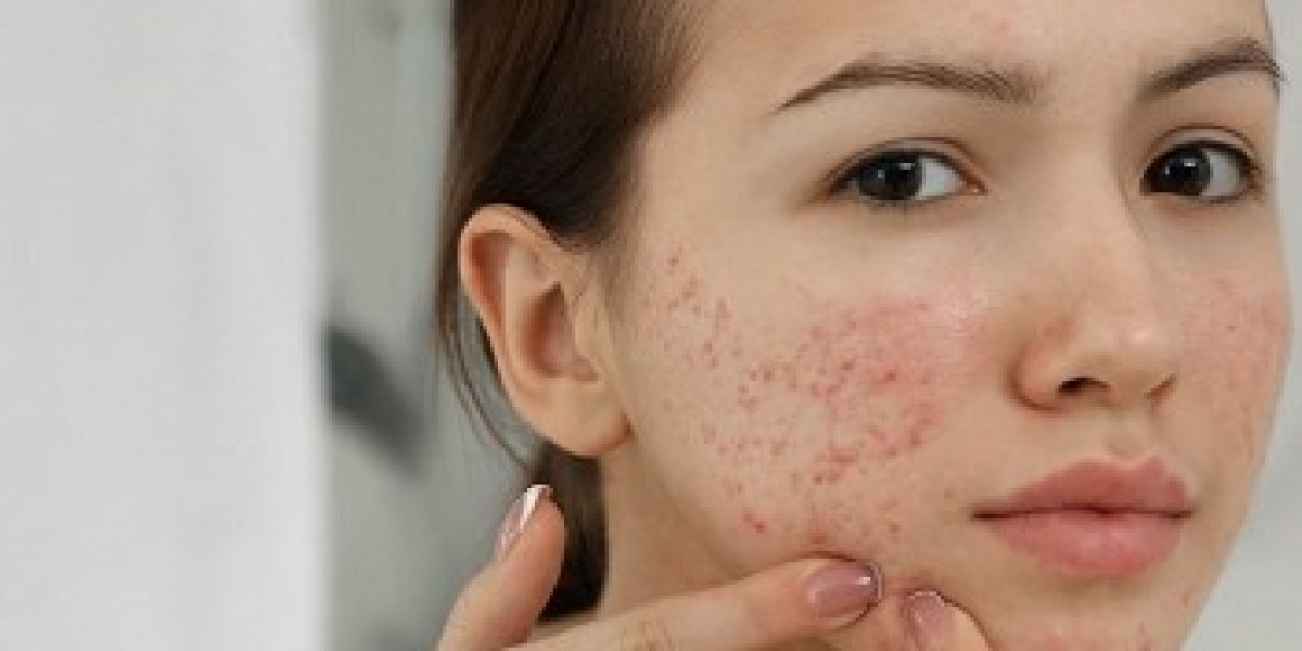 Pimple Treatment in Dubai: Restore Confidence Instantly