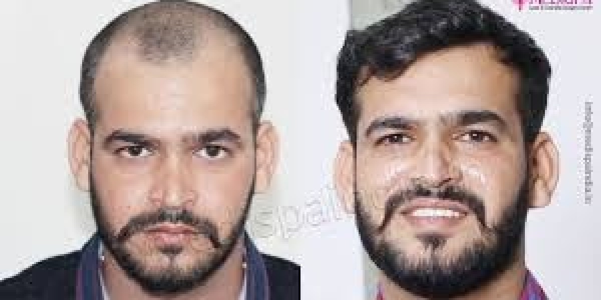 Advanced Hair Transplant in Gurgaon at Opulence Clinic