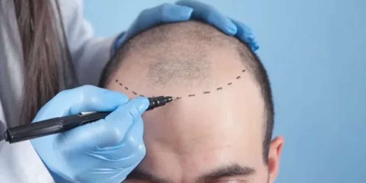 Hair Transplant in Islamabad – Safe, Effective & FDA-Approved Methods
