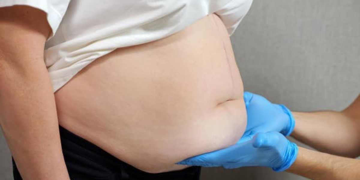 Look Slimmer with Circumferential Abdominoplasty in Dubai