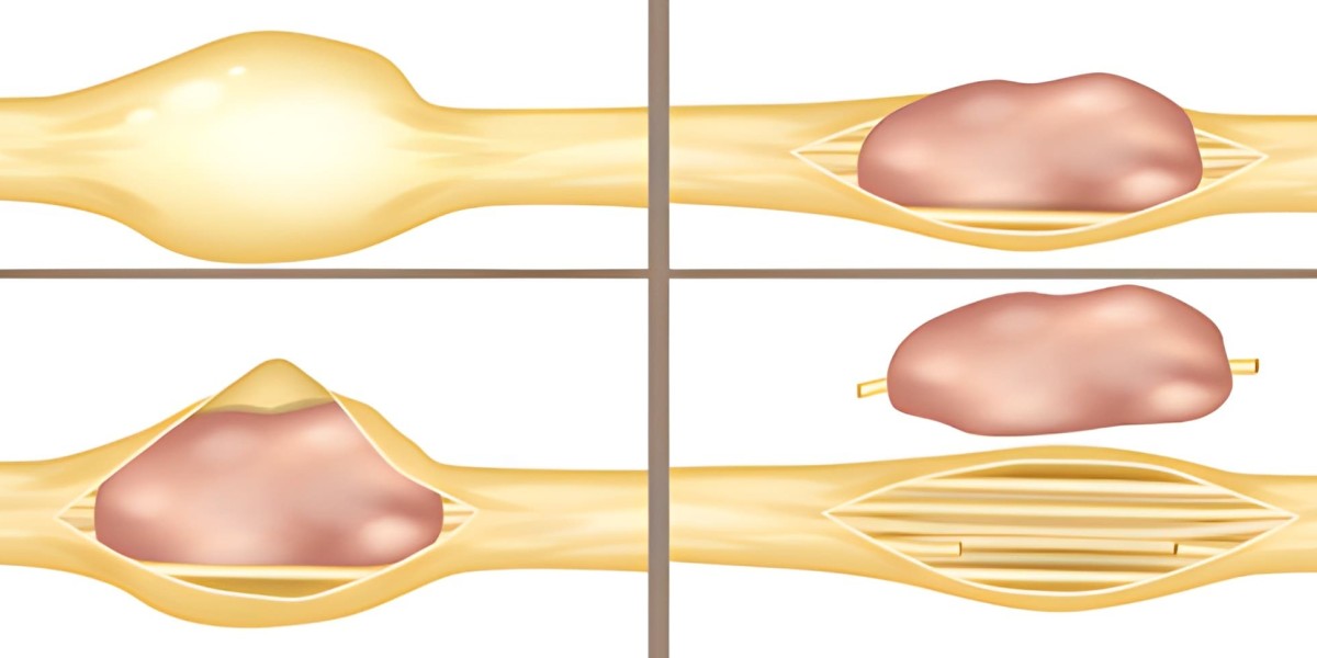 Nerve Sheath Neoplasms: Advances in Diagnosis, Treatment, and Market Landscape