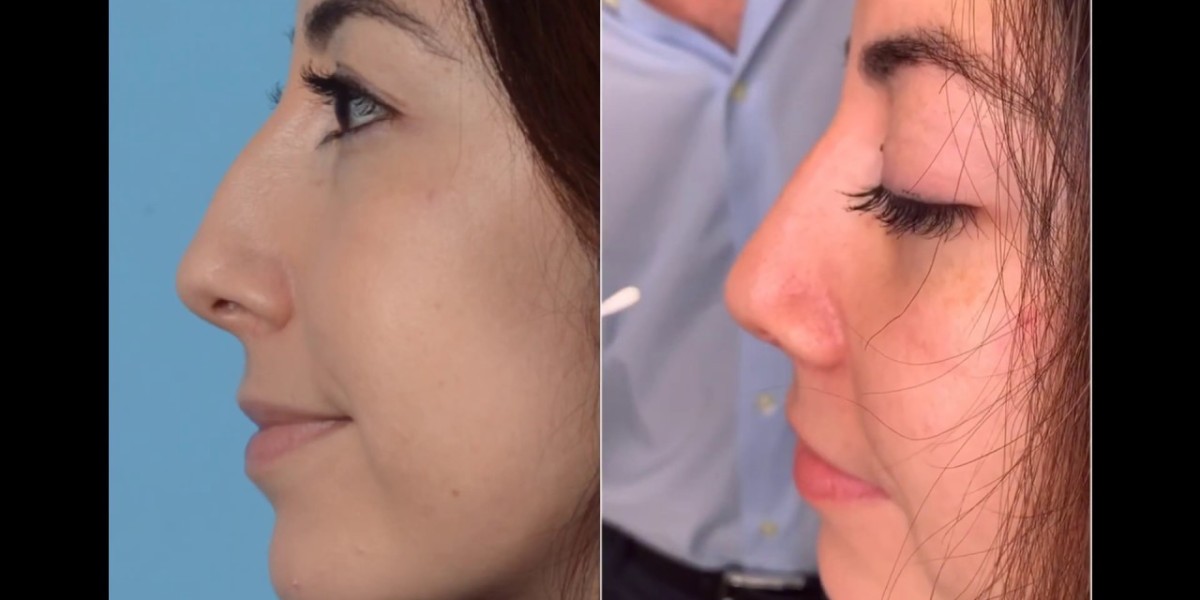 Achieving Natural Looking Nose Job Results
