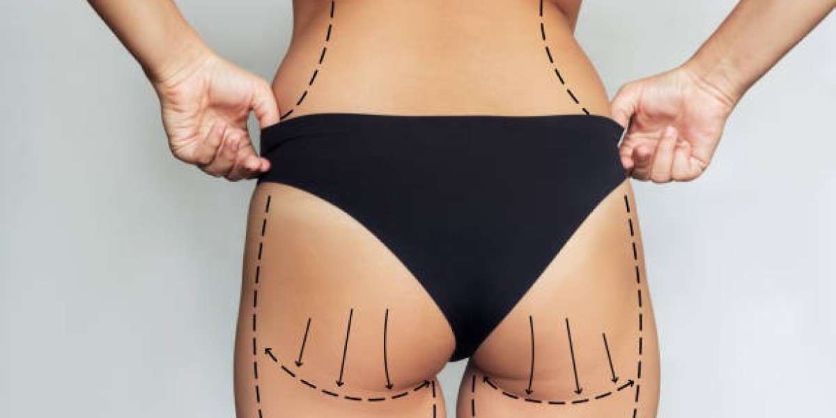 Brazilian Butt Lift Dubai: Latest Techniques 2025