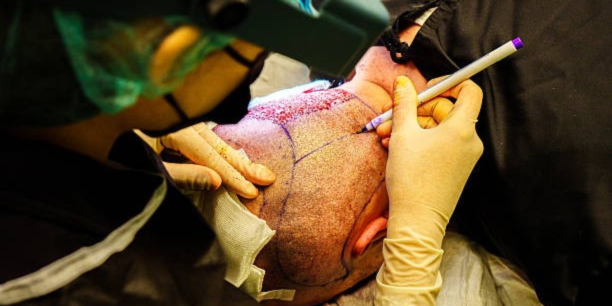 Budgeting for a Hair Transplant in Dubai: What to Expect