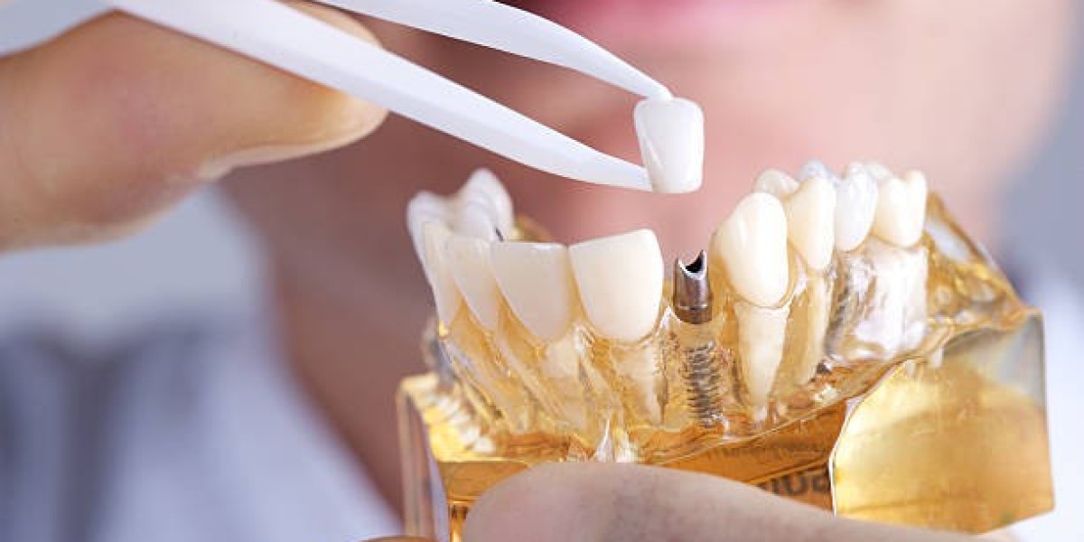 Understanding Dental Implants and Choosing Surgeons in Fort Lauderdale