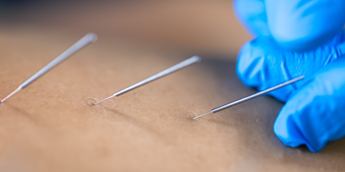 Acupuncture for Hormonal Balance | Hannah Integrative Health