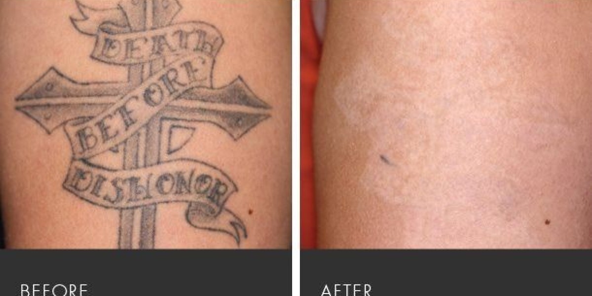Affordable Laser Tattoo Removal in Islamabad