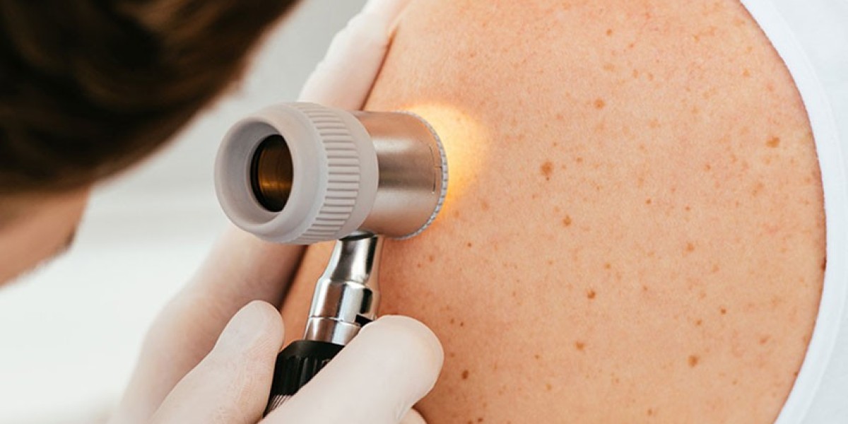 Do Dermatologists in Silicon Oasis Provide Advanced Acne Treatment Solutions?