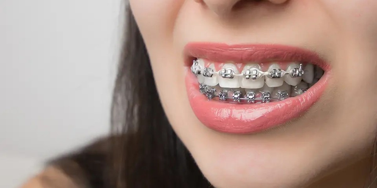 The Ultimate Guide to Metal Braces: Everything You Need to Know
