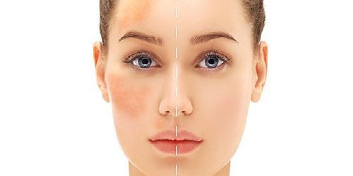 Birthmark Removal in Dubai: Transform Your Skin Safely