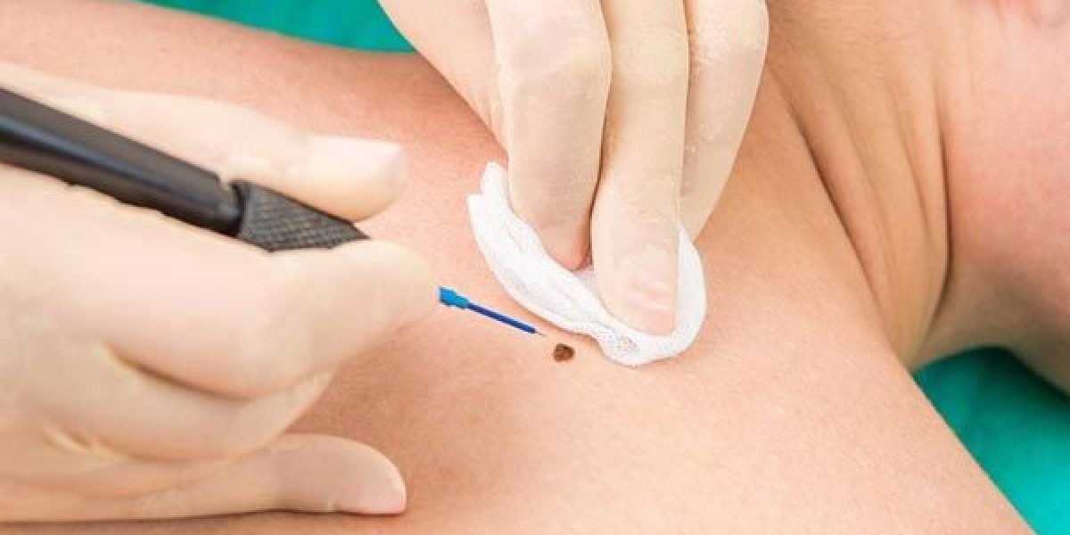Mole Removal in Dubai: When Health Requires Prompt Action