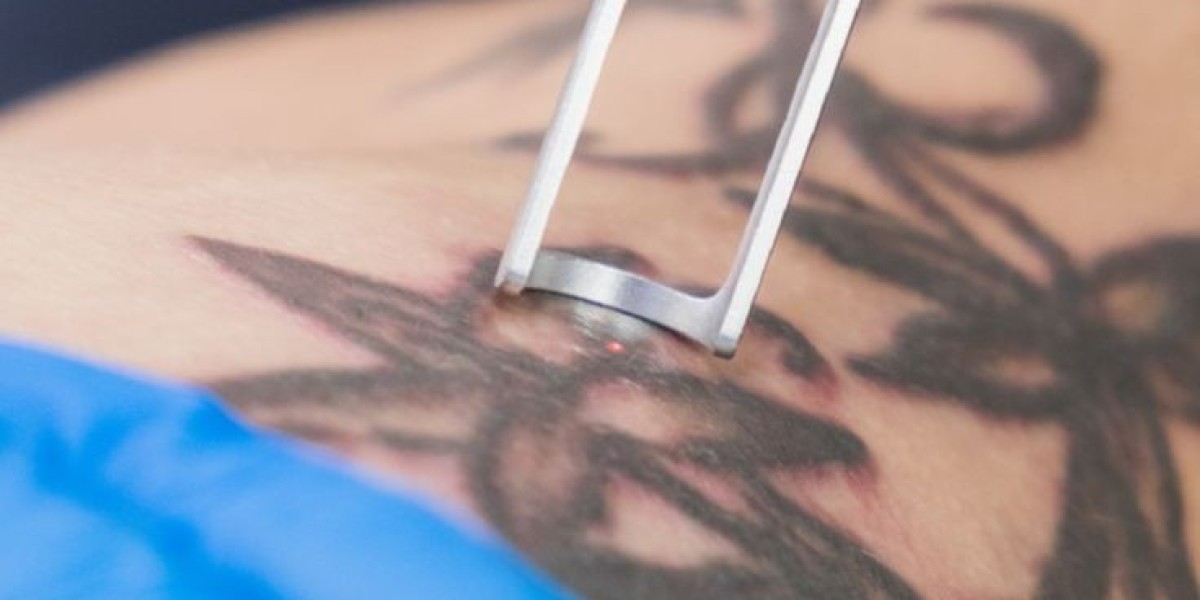 Why Laser Tattoo Removal in Dubai Delivers Better Outcomes
