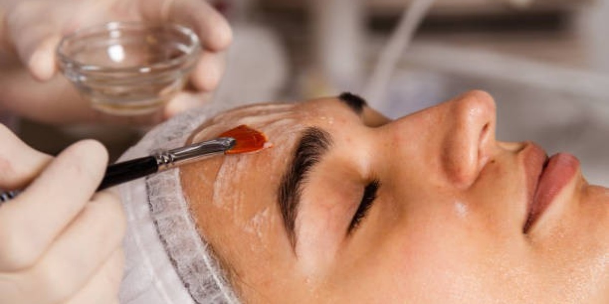 How to Manage Peeling and Redness After a Chemical Peel