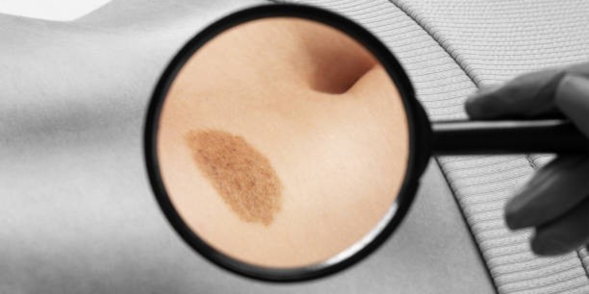Birthmark Removal in Dubai: Clear Skin in a Few Sessions