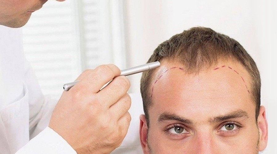 Scarless Hair Transplant in Dubai
