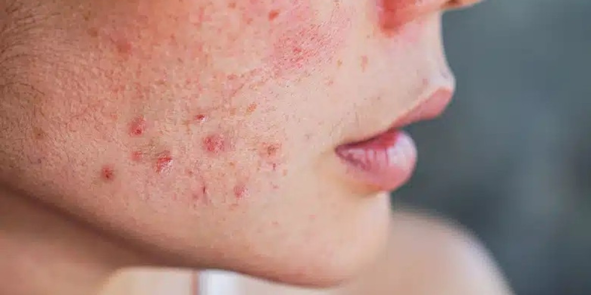 Why Brad Pitt’s Acne Scar Treatment in Dubai Is Trusted by Users?