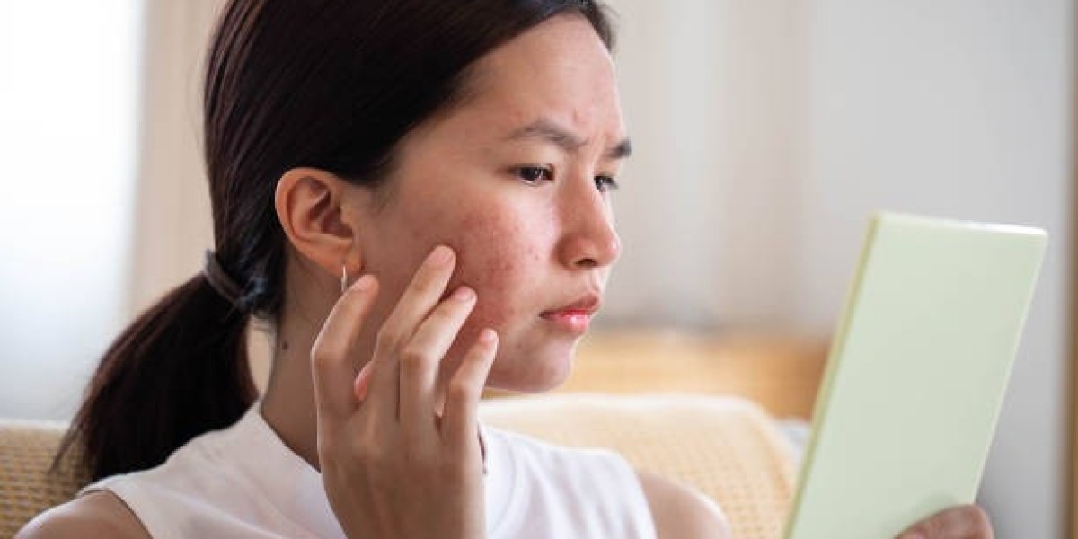 Pimples Treatment to Reduce Redness and Scars