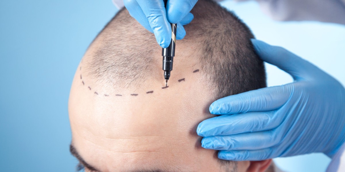 زراعة الشعر للنساء في بريدة