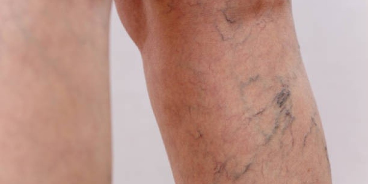 Fundamental Cost of Varicose Vein Treatment Facts