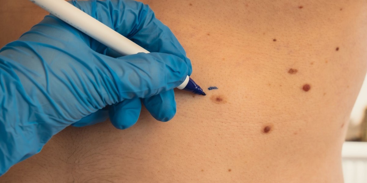 How Accurate Is Dermoscopy Mole Evaluation?