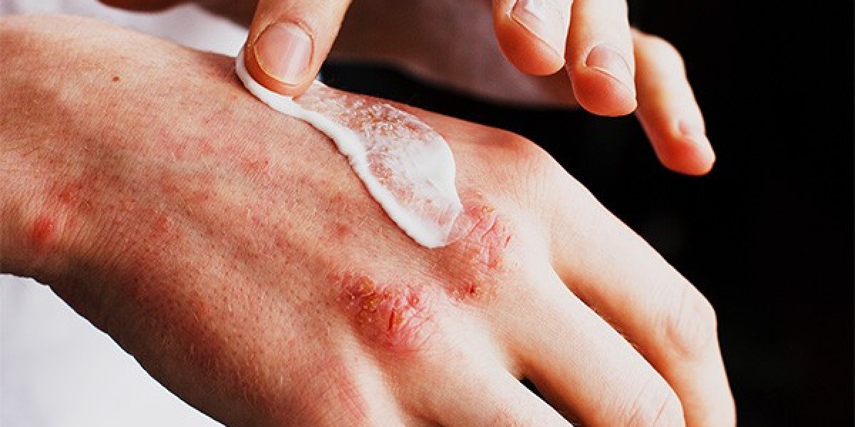 Why the Allergy Treatment Market Is Poised for Strong Growth Through 2034
