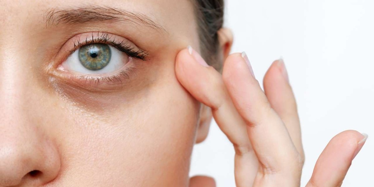 Can a Dermatologist Effectively Treat Dark Circles?