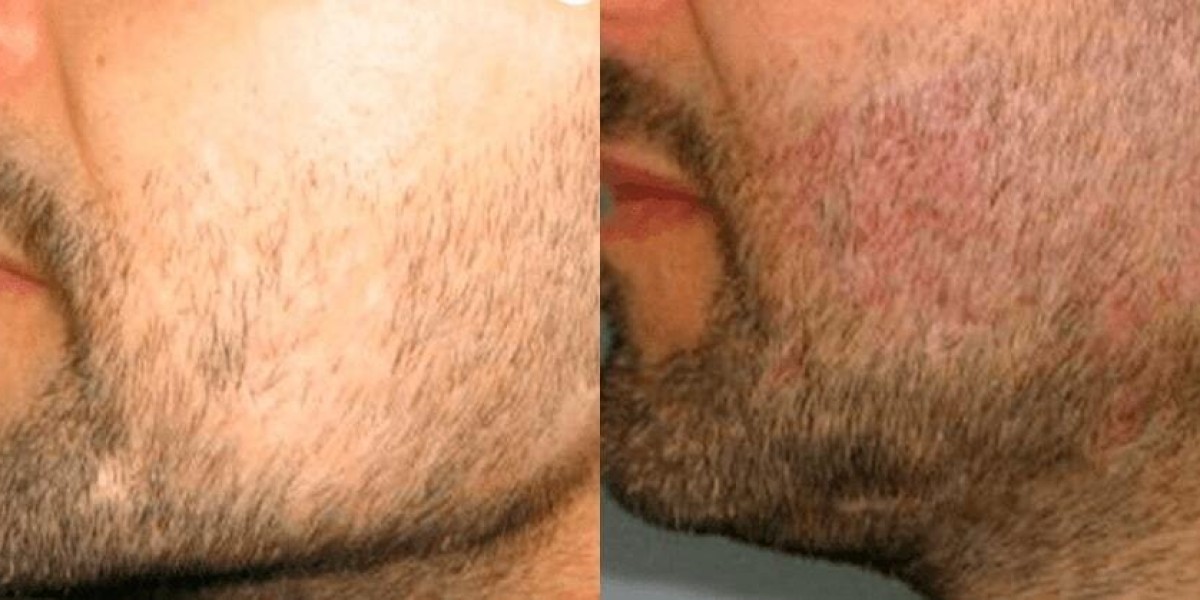 Natural Results with Beard Hair Transplant in Dubai: What You Need to Know