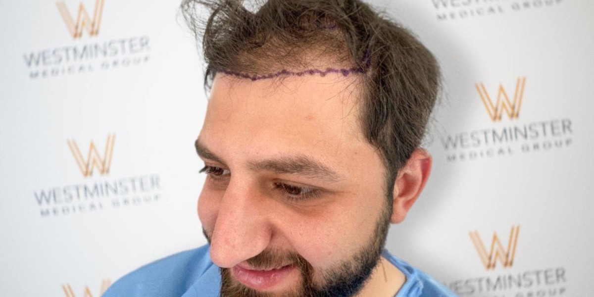 The Rising Demand for Hair Transplant London Services: Why More People Are Choosing Advanced Treatment Options
