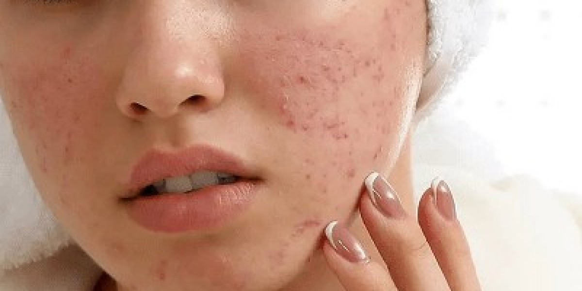 What Is the Best Treatment for Deep Acne Scars?