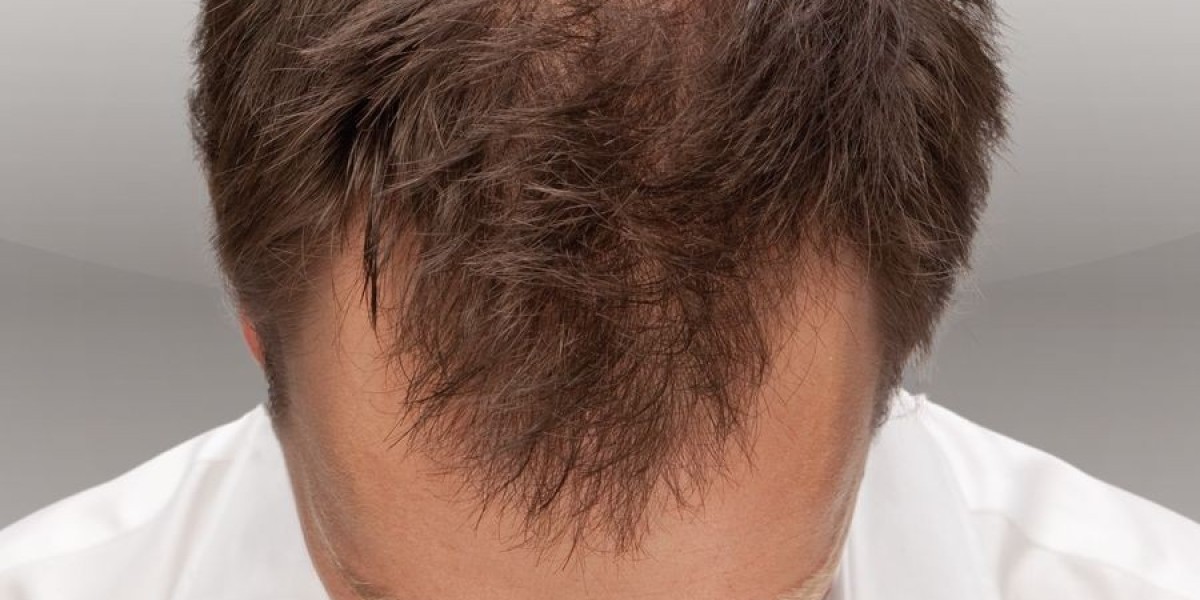 Hair Transplant Success Rate: What You Should Expect