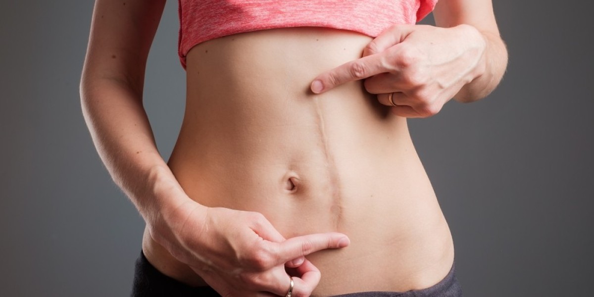 What Skin Concerns Can Laser Scar Removal Effectively Treat?