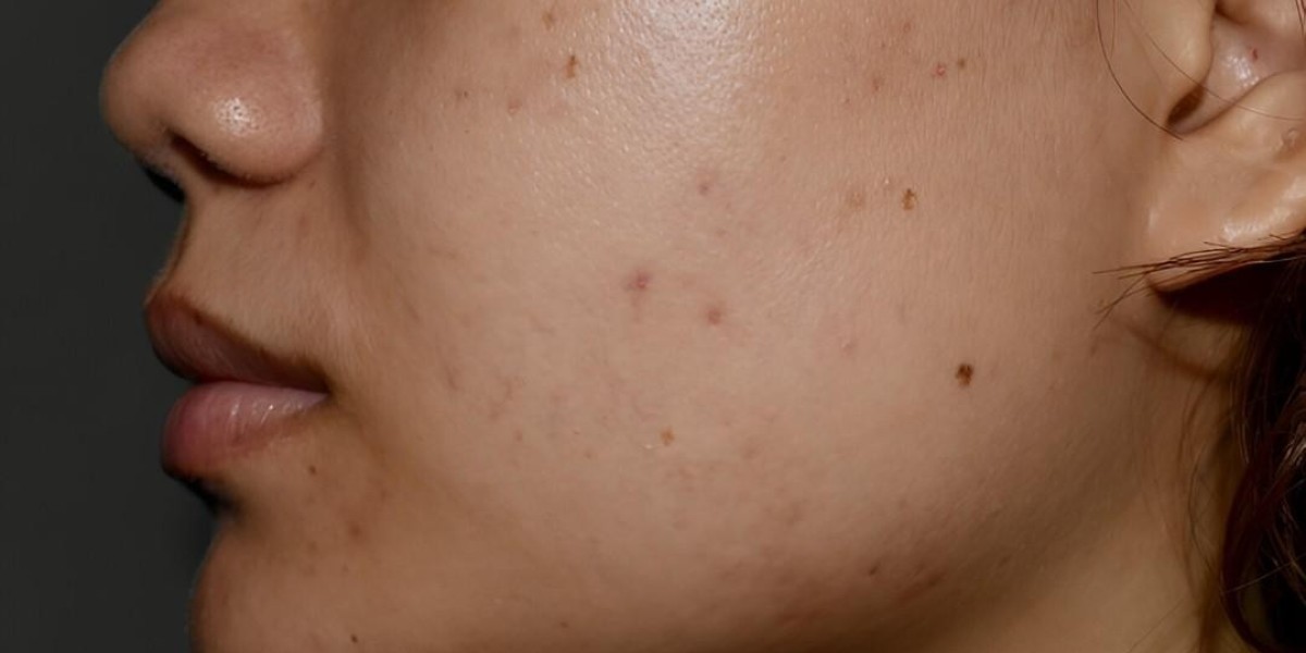 Leading Hyperpigmentation Treatment in Islamabad