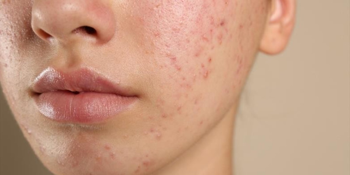 Is Microdermabrasion a Reliable Solution for Acne?