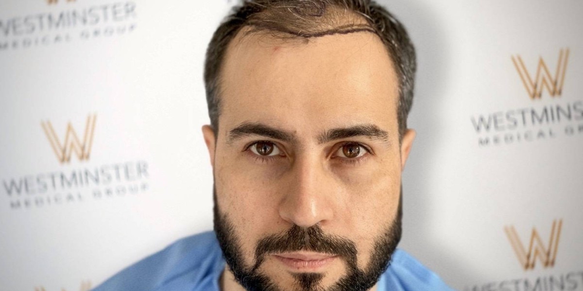 Top 10 Reasons a Hair Transplant Hair Transplant Can Transform Your Confidence