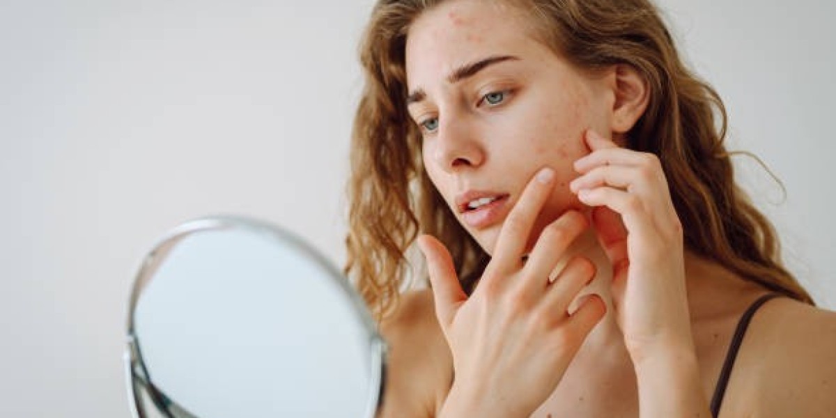 How Lifestyle Affects Your Pimples Treatment Success