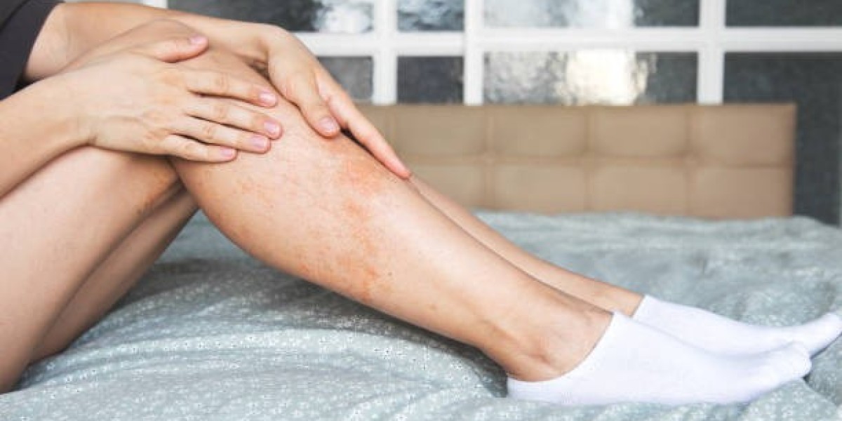 Reliable Birthmark Removal Services in Dubai