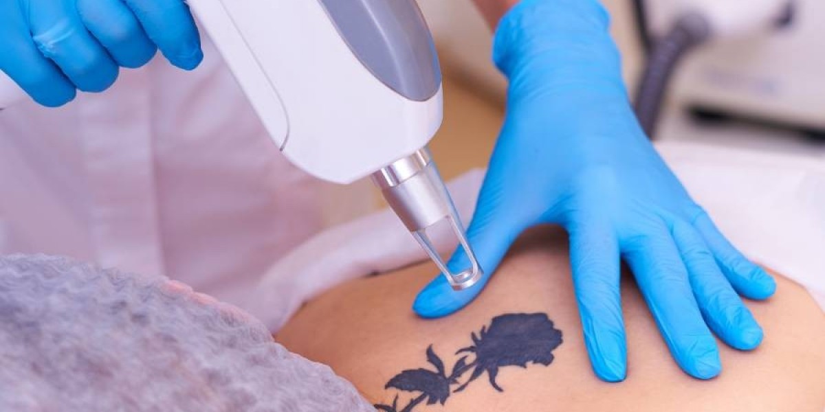 How Many Laser Tattoo Removal Sessions Are Needed?