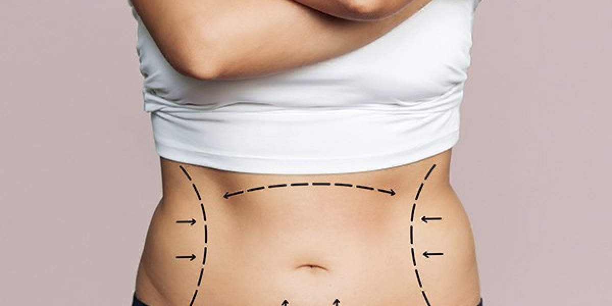 What Is The Usual Price Range For A Standard Tummy Tuck?