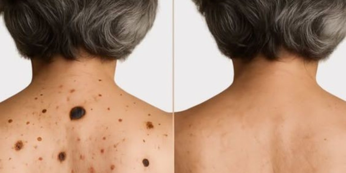 Birthmark Removal in Dubai: How to Prepare for Your Treatment