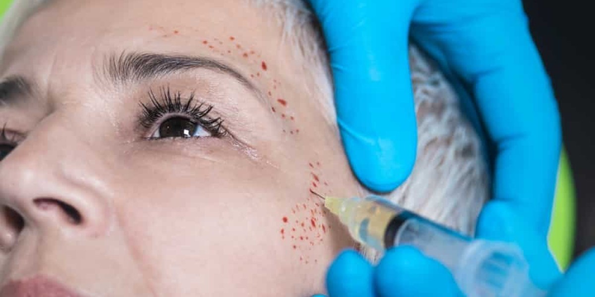 Can a Vampire Facial Treat Dark Spots?