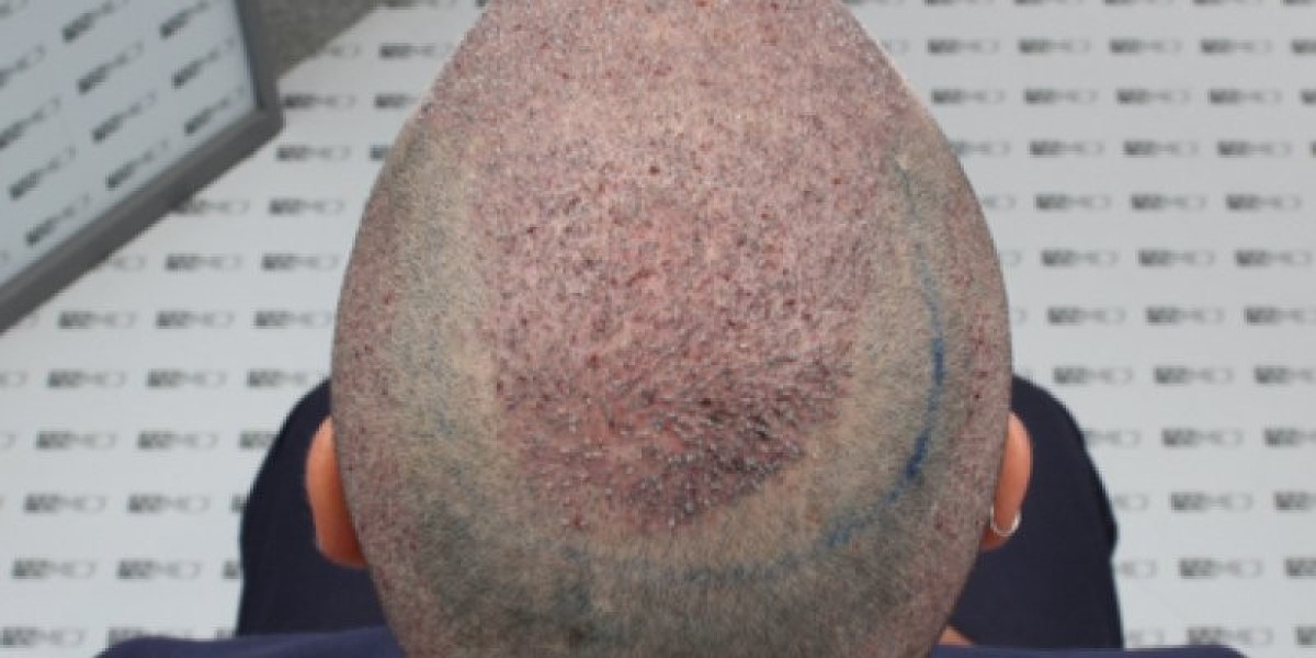 What Are the Different Types of Hair Transplant Procedures?