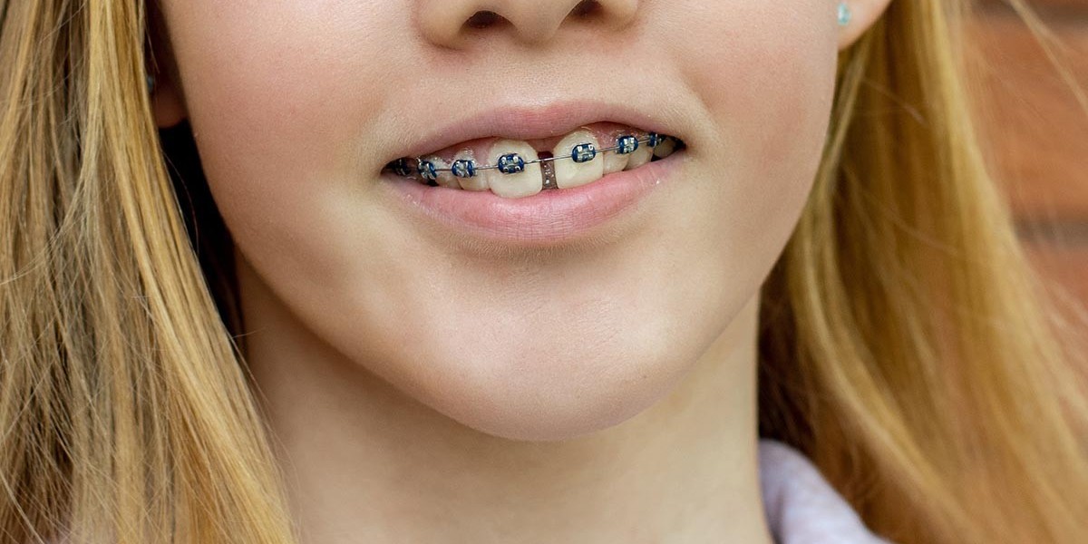 Dental Braces for Teeth Alignment: A Complete Guide