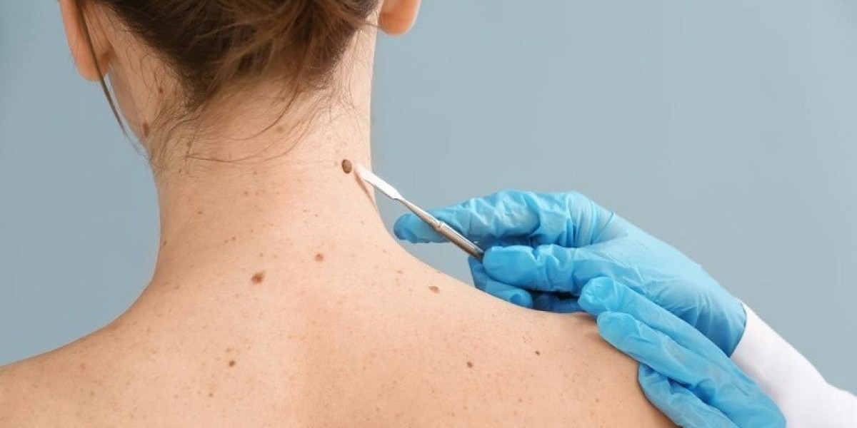 Mole Removal In Dubai: Choosing Between Surgery & Laser