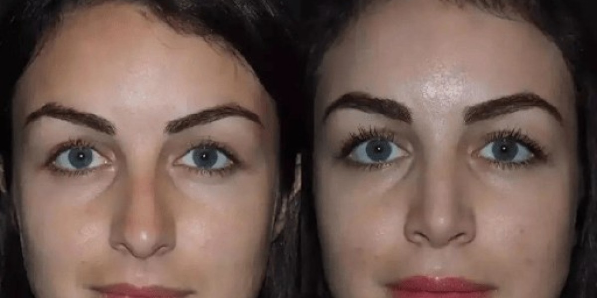 Nose Surgery in Dubai Designed for Facial Balance and Proportion