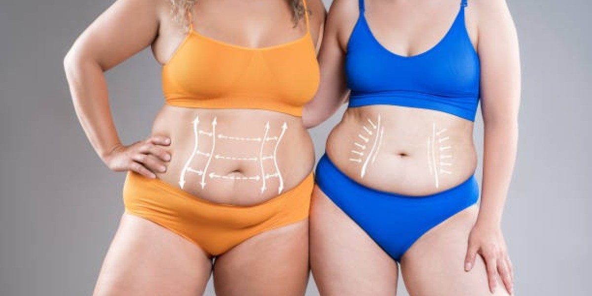 4D Vaser Liposuction Dubai: Precision Fat Removal Explained